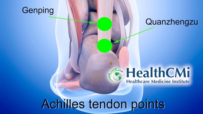 Carpal Tunnel Syndrome & Achilles Tendinopathy Acupuncture 7-19-26